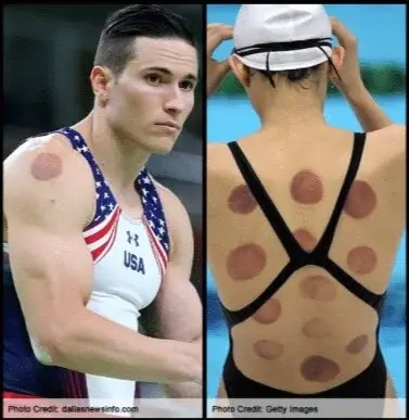 Cupping+Therapy
